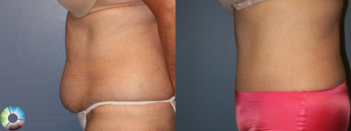 Before & After Tummy Tuck Case 954 Left Side in Denver and Colorado Springs, CO
