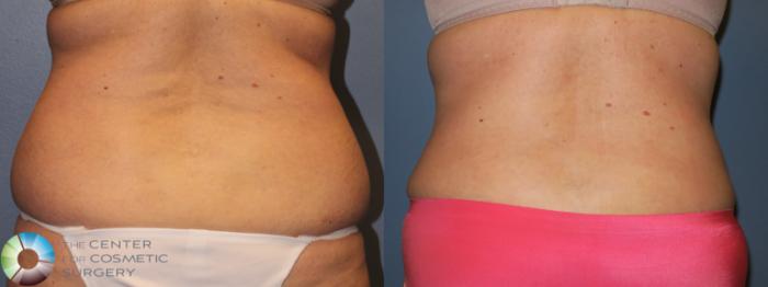 Before & After Tummy Tuck Case 954 Posterior in Denver and Colorado Springs, CO