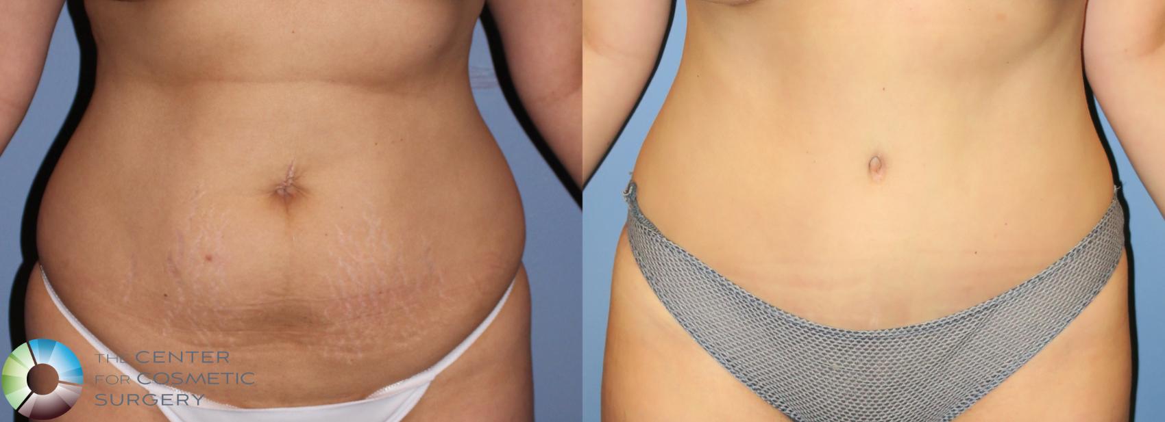 Before & After Tummy Tuck Case 955 View #1 in Denver and Colorado Springs, CO