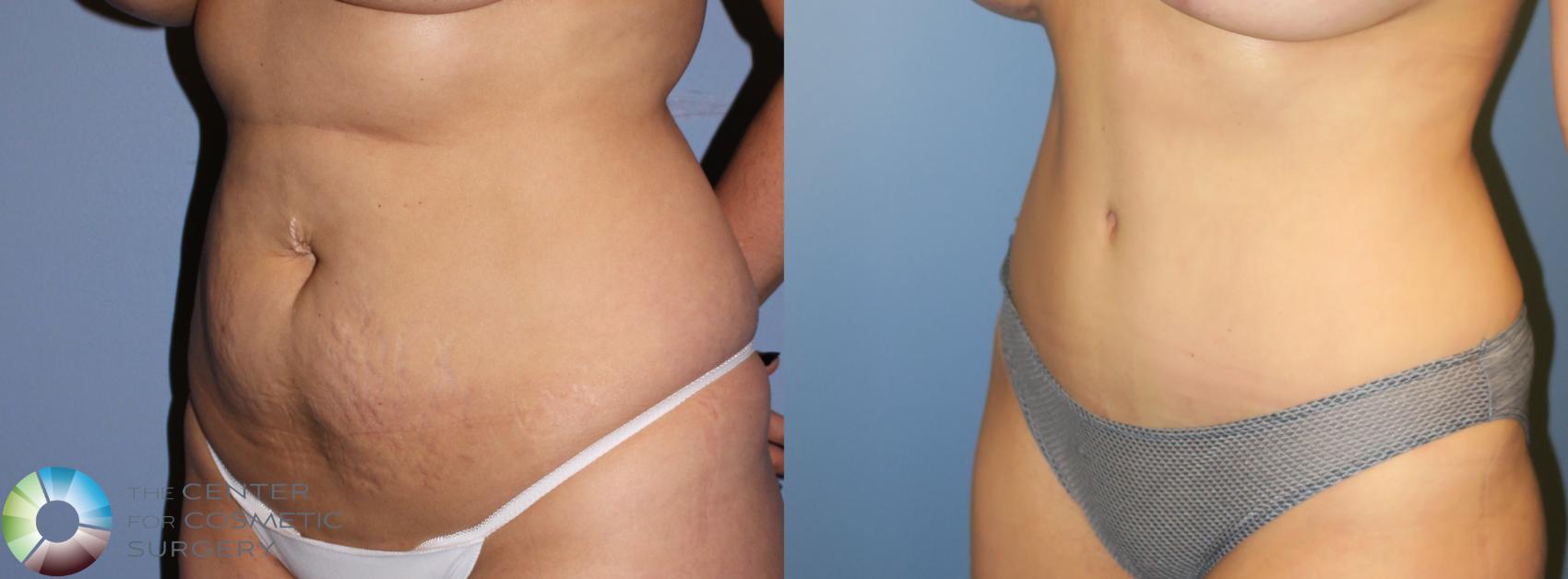 Before & After Tummy Tuck Case 955 View #2 View in Golden, CO