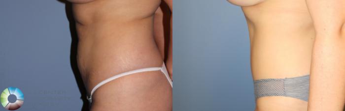 Before & After Tummy Tuck Case 955 View #3 View in Golden, CO