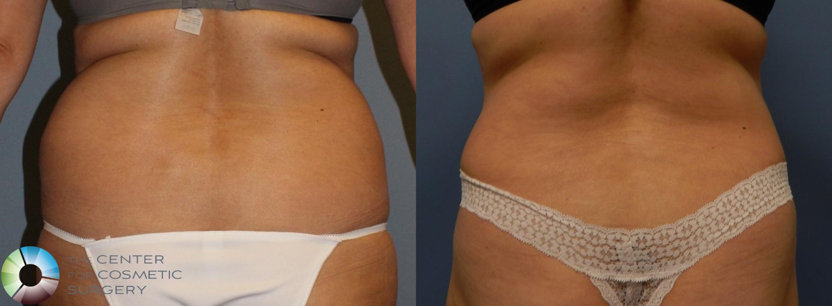 Before & After Power-assisted Liposuction Case 956 View #4 in Denver and Colorado Springs, CO
