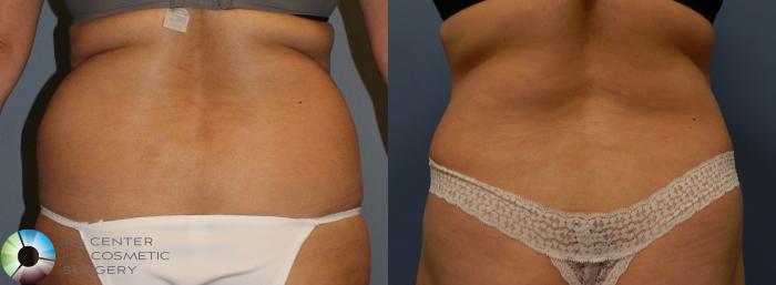 Before & After Power-assisted Liposuction Case 956 View #4 View in Golden, CO