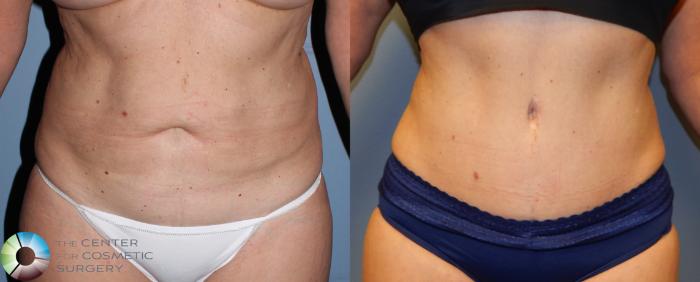 Before & After Tummy Tuck Case 957 View #1 View in Golden, CO