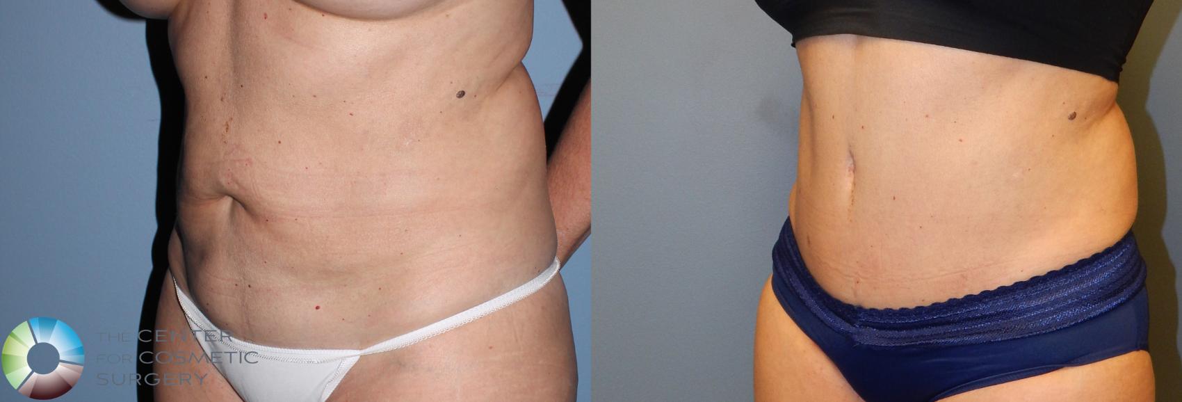 Before & After Tummy Tuck Case 957 View #2 in Denver and Colorado Springs, CO