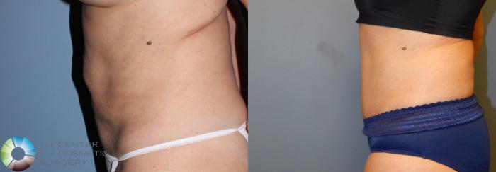 Before & After Tummy Tuck Case 957 View #3 View in Golden, CO