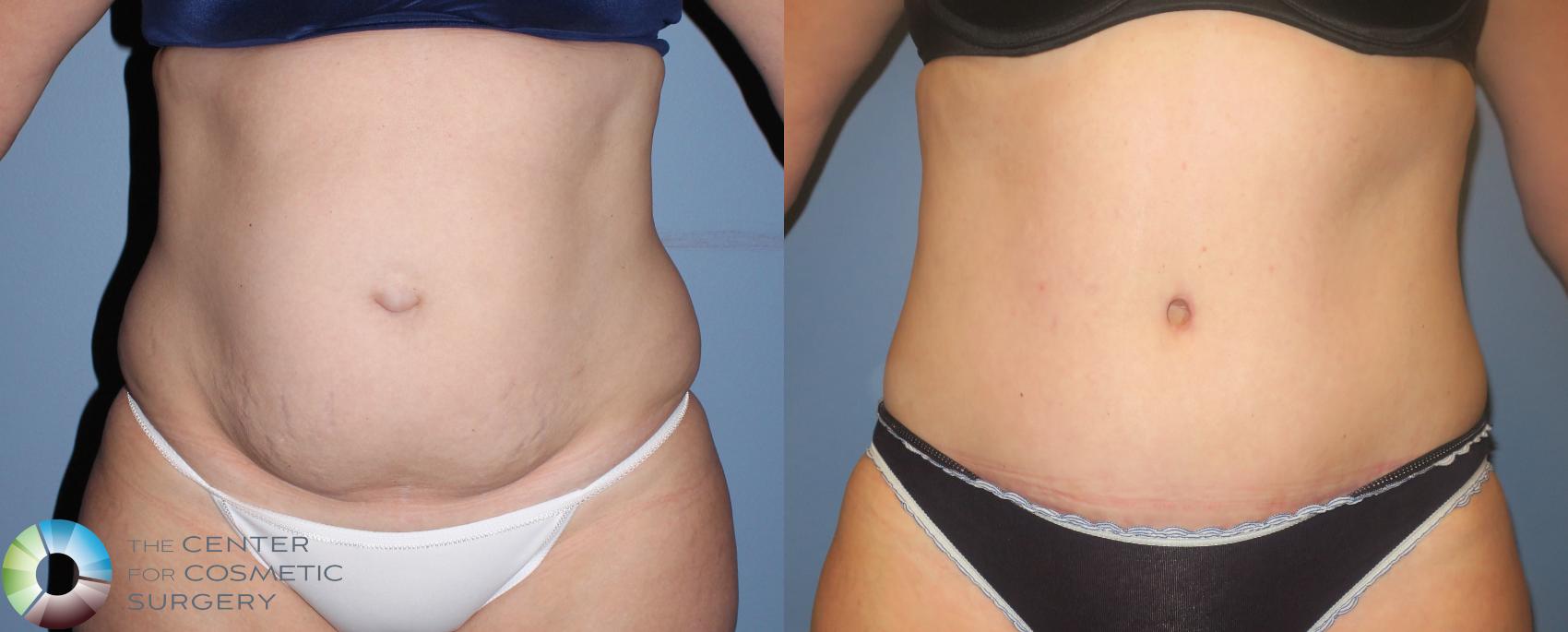 Bexley woman has a tummy tuck after losing 8 stone