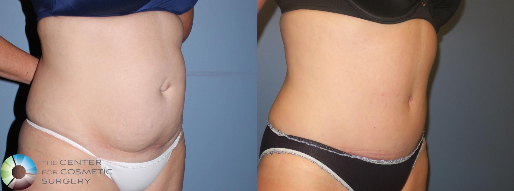 Before & After Tummy Tuck Case 958 View #2 in Denver and Colorado Springs, CO