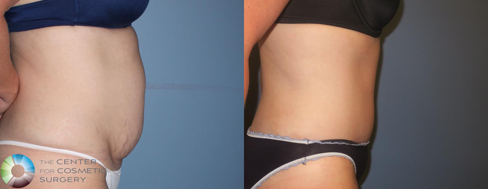 Before & After Tummy Tuck Case 958 View #3 in Denver and Colorado Springs, CO