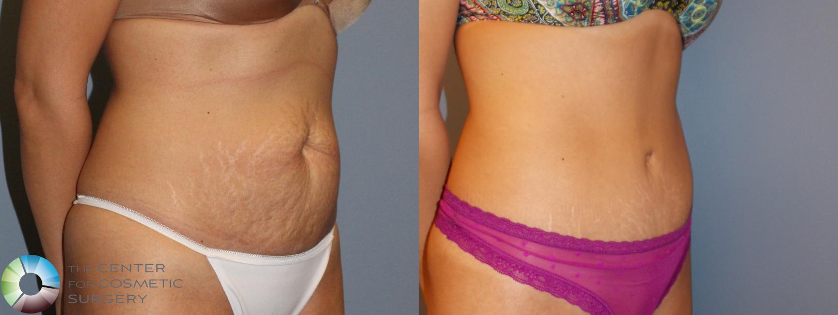 Before & After Tummy Tuck Case 959 View #1 in Denver and Colorado Springs, CO