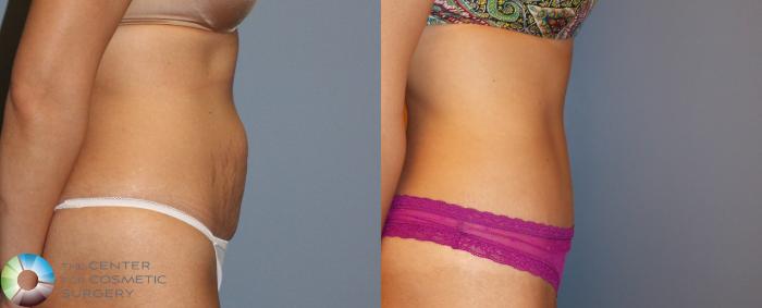 Before & After Tummy Tuck Case 959 View #2 View in Golden, CO