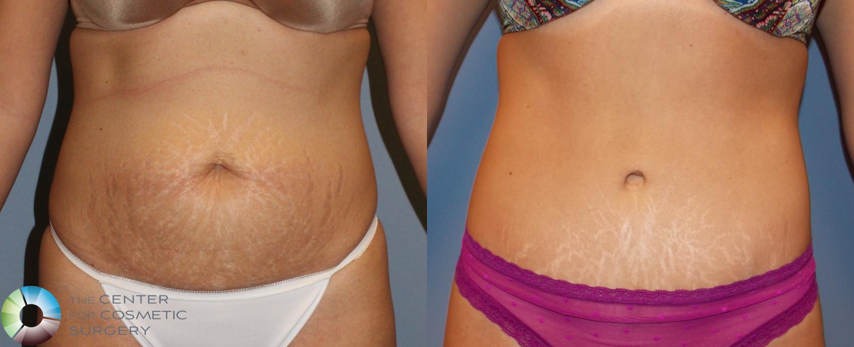 Before & After Tummy Tuck Case 959 View #3 View in Golden, CO