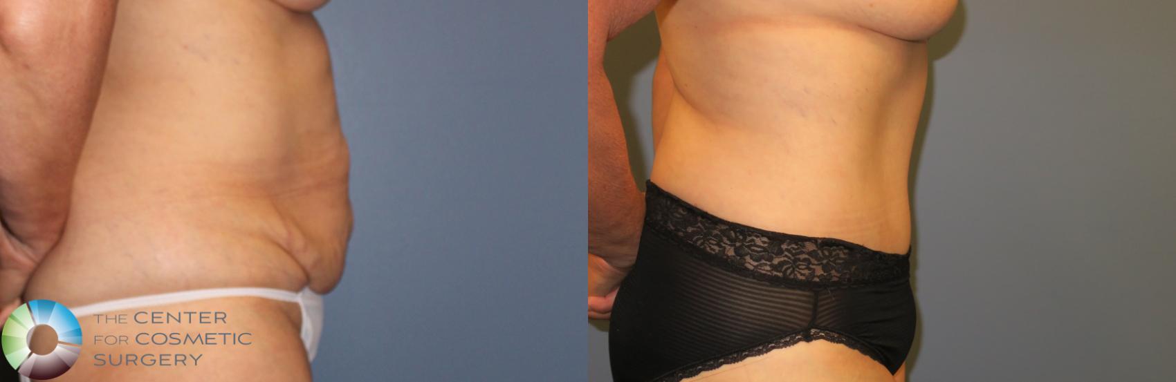 Before & After Tummy Tuck Case 962 View #1 in Denver and Colorado Springs, CO