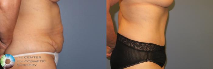 Before & After Tummy Tuck Case 962 View #1 View in Golden, CO