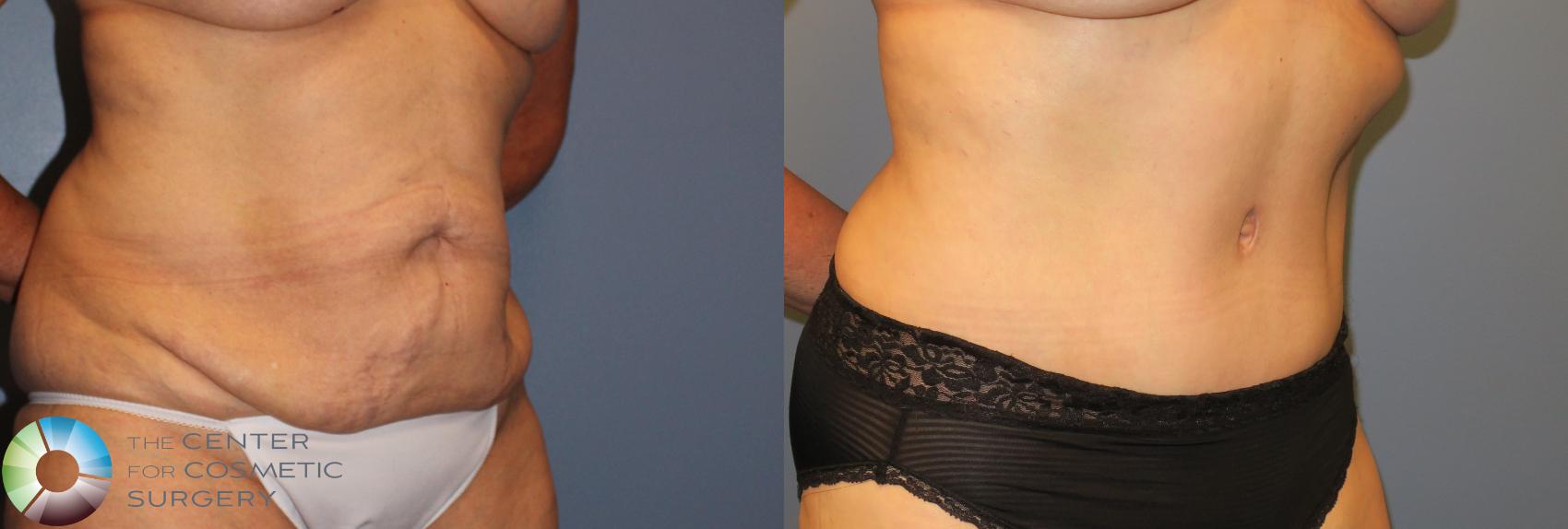 Before & After Tummy Tuck Case 962 View #2 in Denver and Colorado Springs, CO