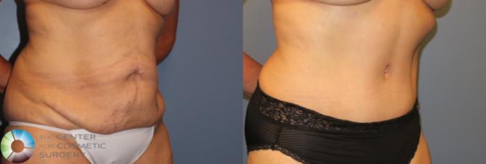 Before & After Tummy Tuck Case 962 View #2 View in Golden, CO