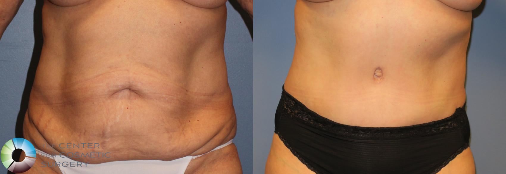 Before & After Tummy Tuck Case 962 View #3 in Denver and Colorado Springs, CO