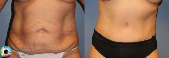 Before & After Tummy Tuck Case 962 View #3 View in Golden, CO