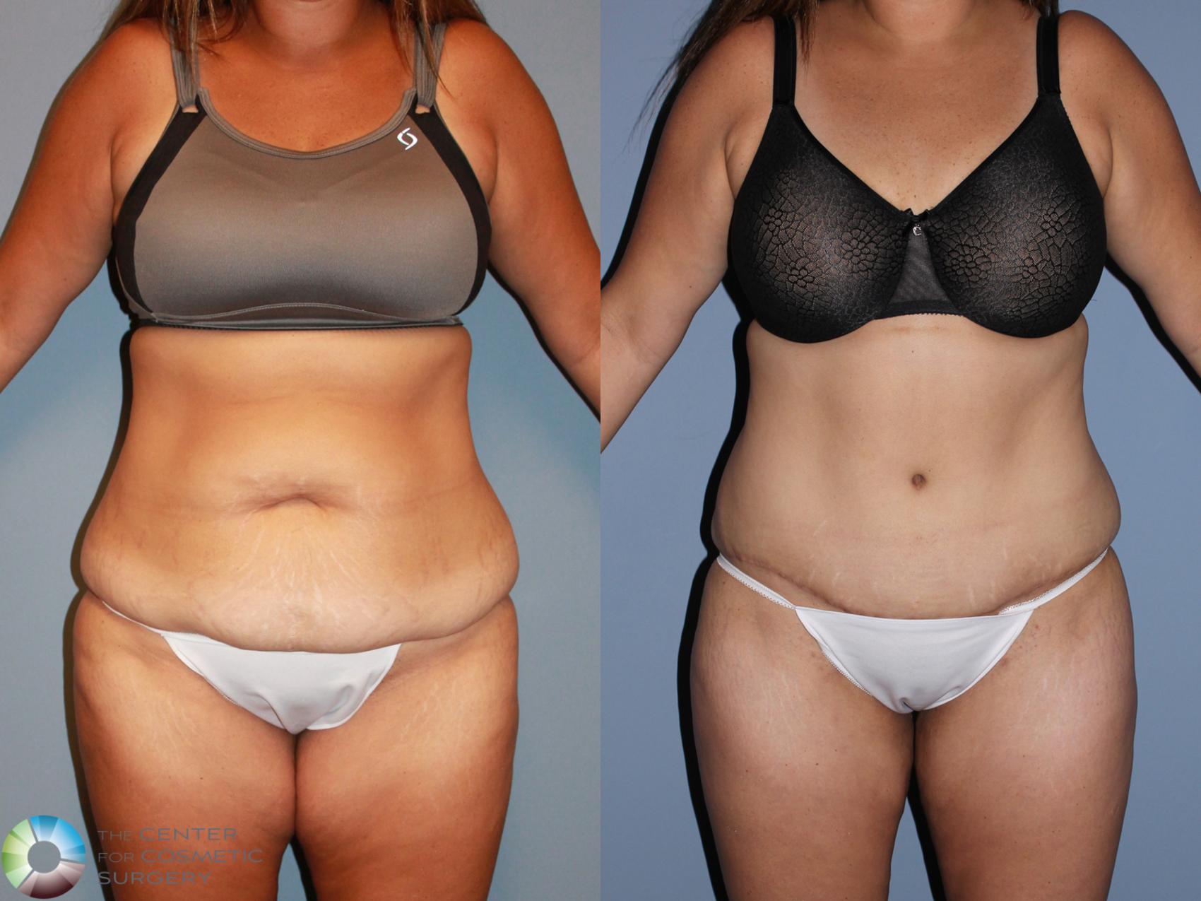 Before & After Tummy Tuck Case 994 View #1 in Denver and Colorado Springs, CO