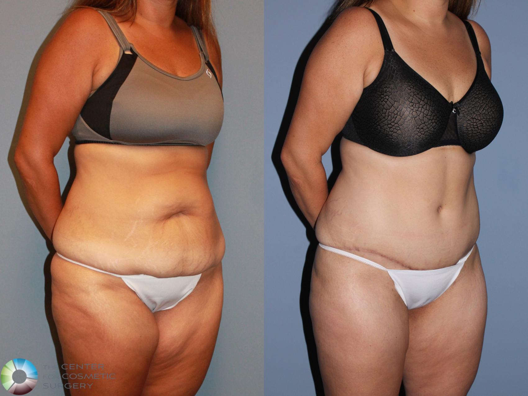 Before & After Tummy Tuck Case 994 View #2 View in Golden, CO