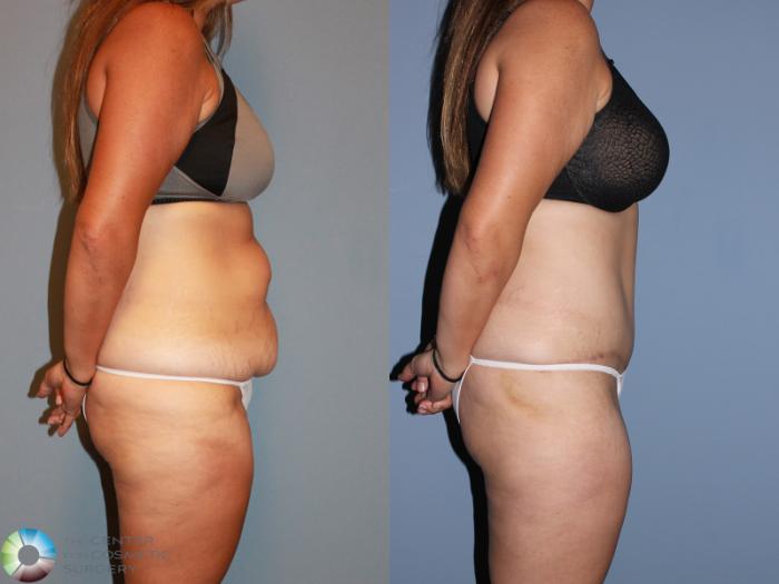Before & After Tummy Tuck Case 994 View #3 View in Golden, CO